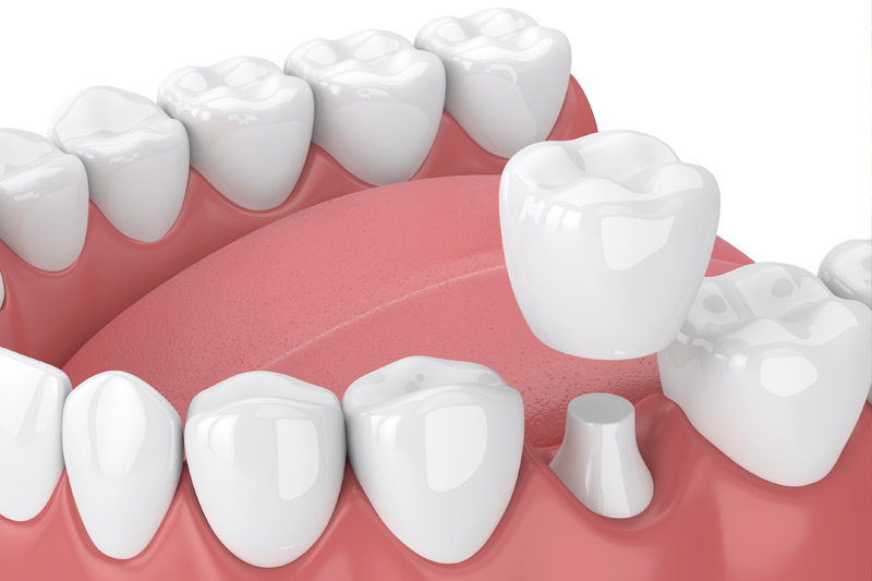 Dental Crowns in Gladstone, North Kansas City