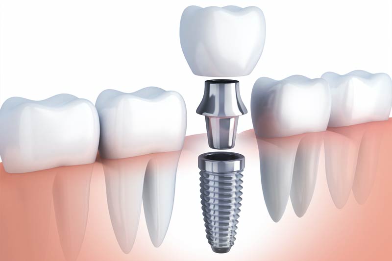 Emergency Dentist in Gladstone, North Kansas City