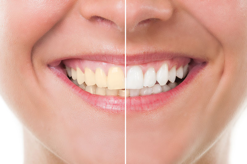 Teeth Whitening in Gladstone, North Kansas City