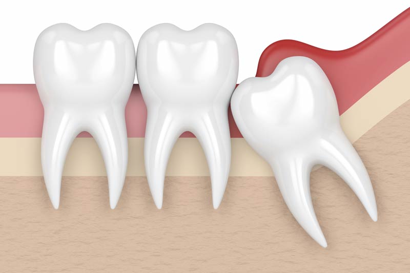 Wisdom Tooth Removal in Gladstone, North Kansas City
